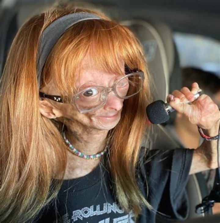 Who was Adalia Rose? Wiki, Biography, Net worth, Disease, Death, Parents, Height, Age & More